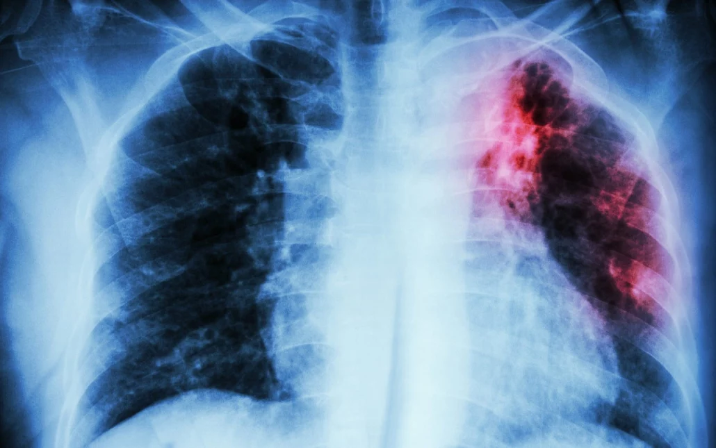 Untuk Pertama Kali Setelah 20 Tahun, WHO Sebut Kasus TBC Kembali Meningkat