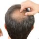 Mengenal Alopecia Areata yang Membuat Rambut Rontok Tiba-Tiba