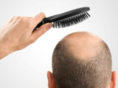 Mengenal Alopecia Areata yang Membuat Rambut Rontok Tiba-Tiba